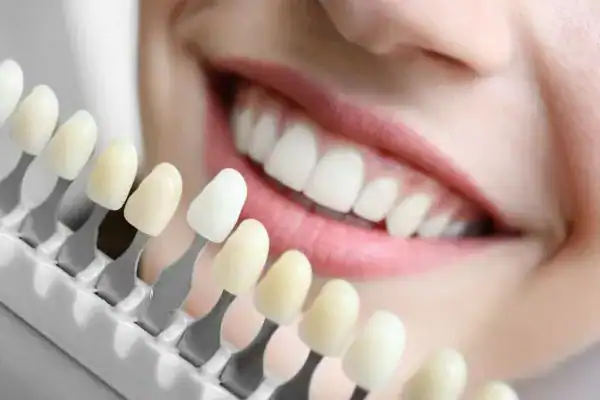 laser whitening Faqs Kettering